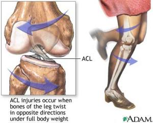 ACL: Anatomy and Mechanism of Injury